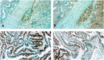 Microsatellite instability and mismatch repair protein deficiency: equal predictive markers?